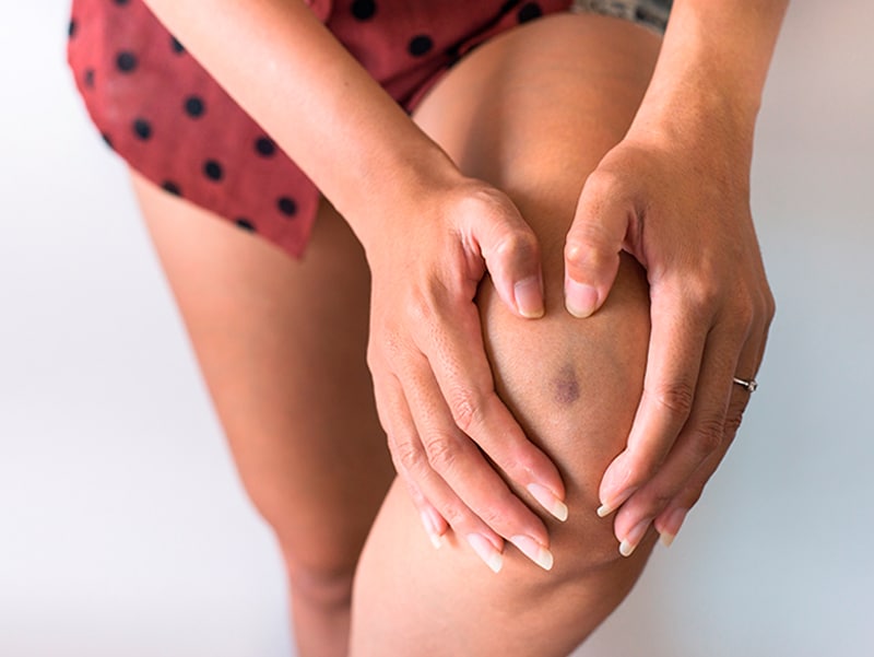 woman holding her knee with a bruise on it