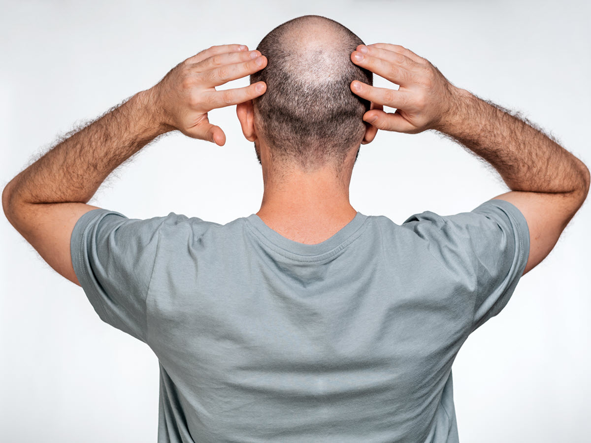 man touching his bald head from behind