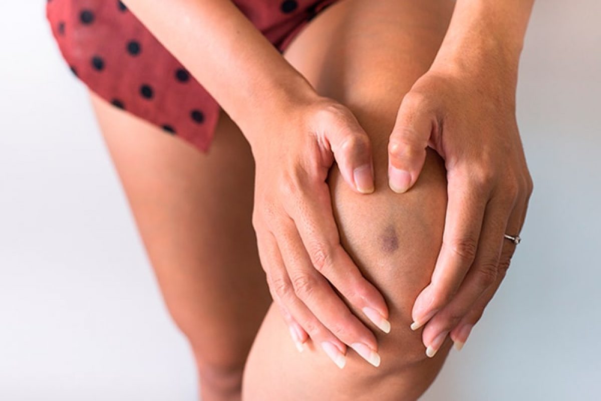 woman holding her knee with a bruise on it