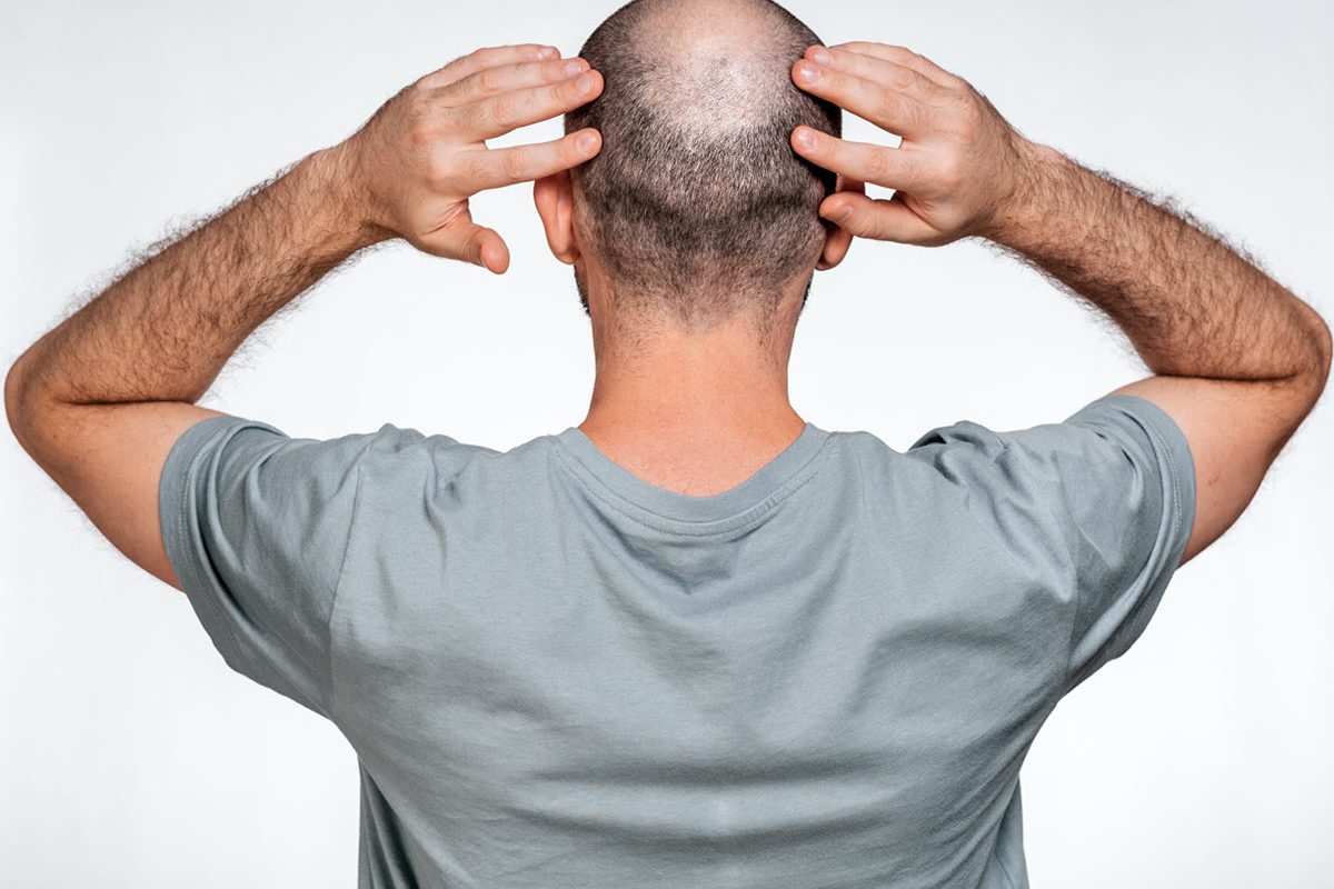 man touching his bald head from behind